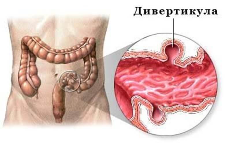 Exercises for diverticulosis of the sigmoid colon
