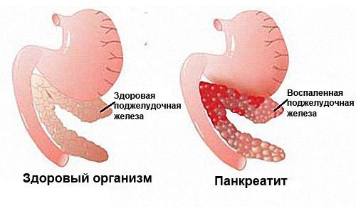 types of pancreatitis