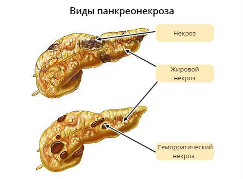 Виды панкреонекроза