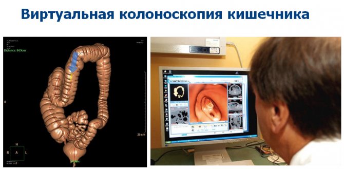 Virtual colonoscopy of the intestines