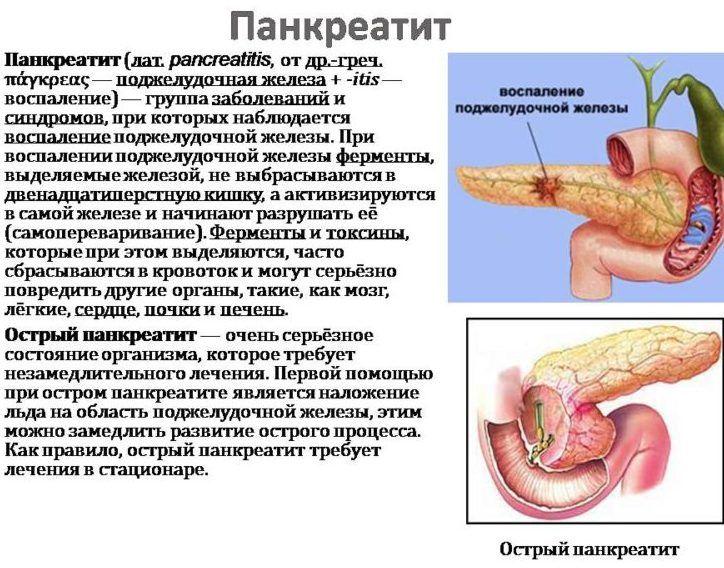 Inflammation of the pancreas