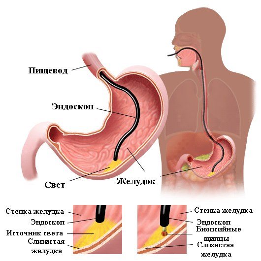 endoscope insertion