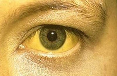 Yellowness of the sclera