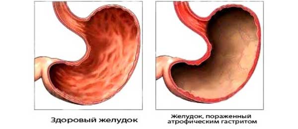 Stomach affected by gastritis